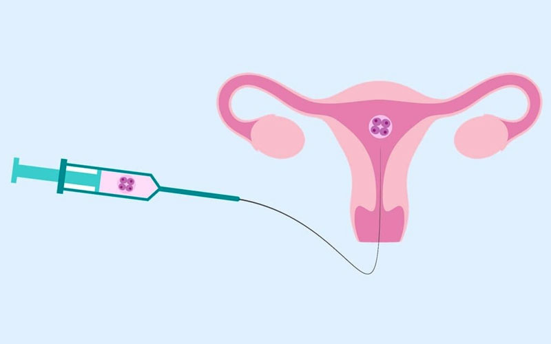iui pic